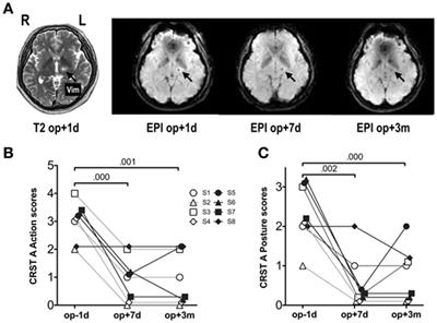 Hierarchical Dynamic Causal Modeling of Resting-State fMRI Reveals Longitudinal Changes in Effective Connectivity in the Motor System after Thalamotomy for Essential Tremor